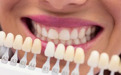 Carillas Dentales