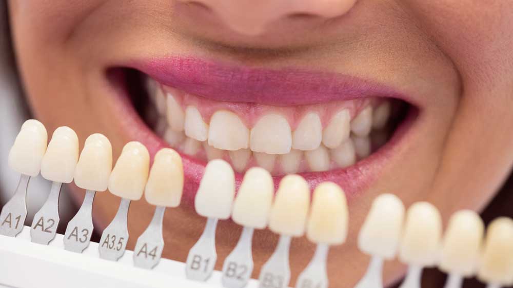 Carillas Dentales Centro Médico Gava
